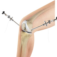 Knee Arthroscopy