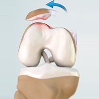 Chondral Articular Cartilage Defects