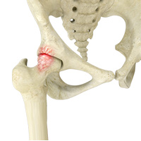 Femoroacetabular Impingements