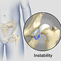 Hip Instability