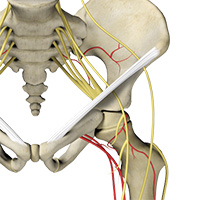 Hip Joint Reconstruction