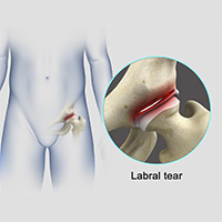 Hip Labral Tear