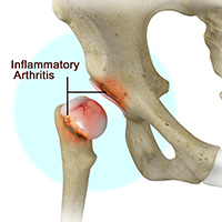 Inflammatory Arthritis of the Hip