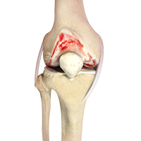 Knee Arthritis