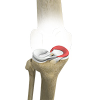 Medial Meniscus Syndrome