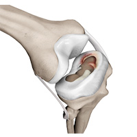 Meniscal Injuries