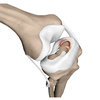 Meniscal Tears