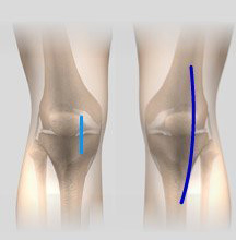 Minimally Invasive Knee Replacement Incisions