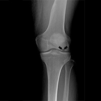 Osteonecrosis of the Knee