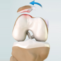 Recurrent Patella Dislocation