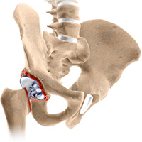 Revision Hip Replacement