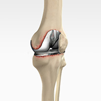 Revision Knee Replacement