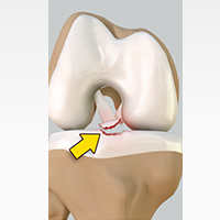 Tibial Eminence Spine Avulsions