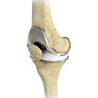 Total Knee Replacement