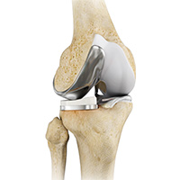 Unicompartmental Knee Replacement